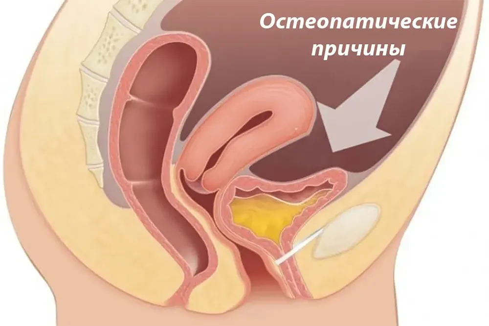 Стрессовое недержание мочи